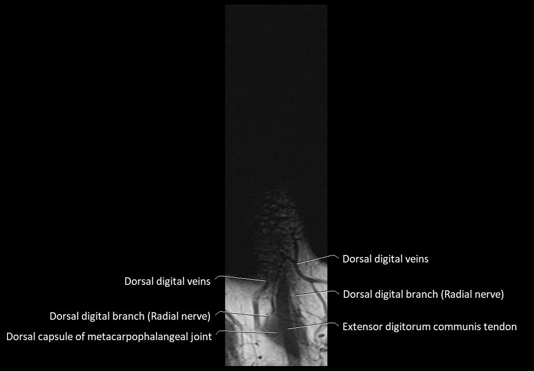 Finger anatomy coronal cross section 3TMRI labelled  image 1.webp